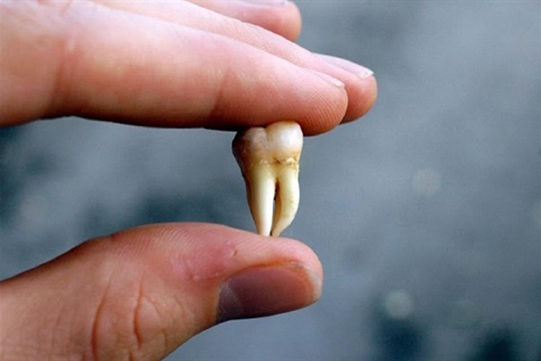 دراسة طبية تكتشف ثورة في علاج الأمراض المعقدة بخلايا ضرس العقل